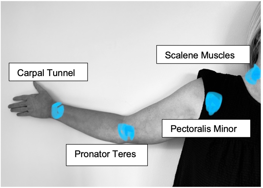 Suffering from Carpal Tunnel Syndrome? Relieve Pain!