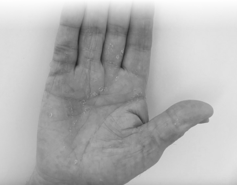 treatment for dupuytren's disease | The Hands Physio