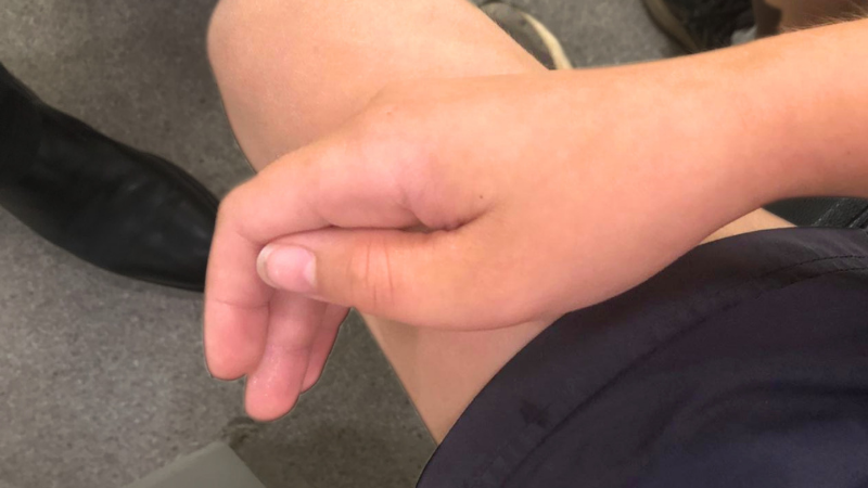 Swollen thumb following a dislocation injury, showing visible swelling around the thumb joint before assessment and treatment at Action Rehab - The Hands Physio.